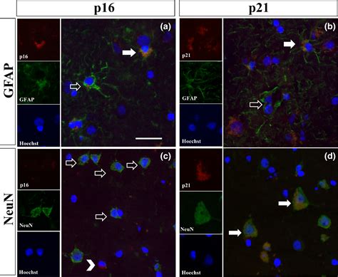 Expression Of P16 And P21 In The Frontal Association Cortex Of ALS MND