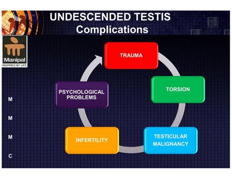 Cryptorchidism Undescended Testis