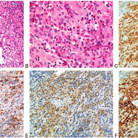 Hematoxylin Eosin Staining Indicates A Proliferation Of Large Cells