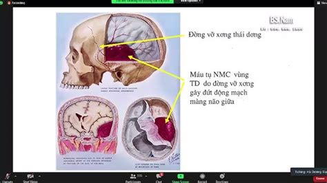 Bài Giảng Chấn Thương Sọ Não Y Hà Nội Hướng Dẫn Toàn Diện Từ Chẩn Đoán Đến Điều Trị