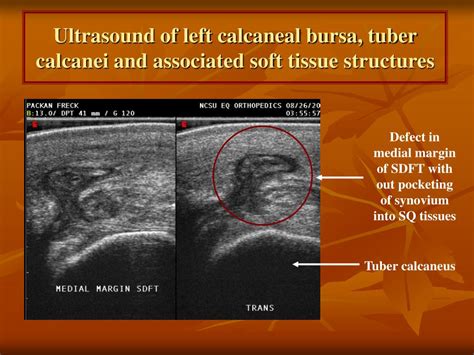 Plantar Calcaneal Bursitis