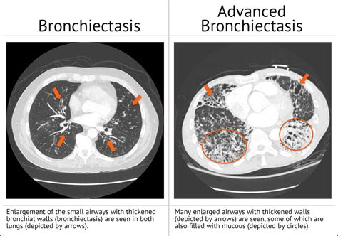 Bronchiectasis Faqs Bronchiectasis And Ntm Initiative