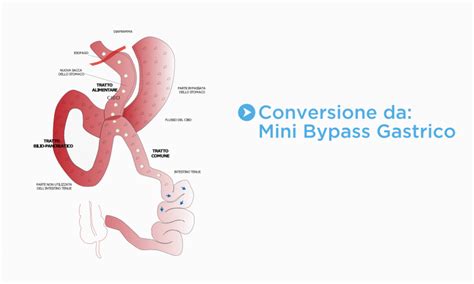 Conversione Da Mini Bypass Gastrico Dott Federico Messina