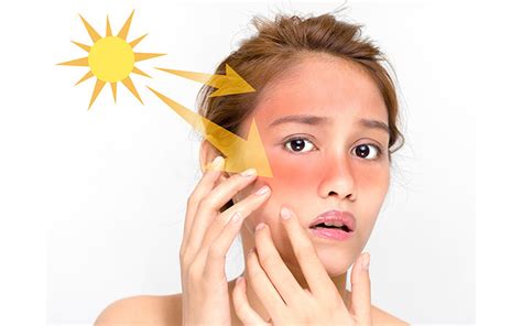 Sunburn On Face: Causes, Symptoms, Treatments & Preventive Tips – Vedix