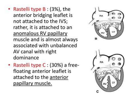 Atrioventricular canal defect | PPT