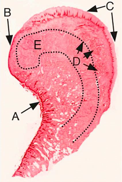 Figure 4 from Lip reduction surgery (reduction cheiloplasty ...