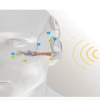 (PDF) Hybrid Cochlear Implant