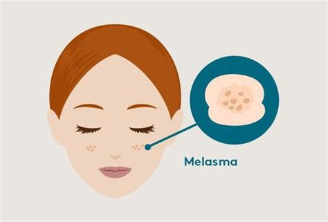 Melasma causes treatment prevention – Artofit