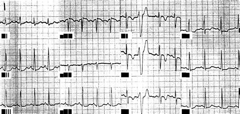 Arrhythmogenic Right Ventricular Cardiomyopathy Diagnosis Prognosis And Treatment Heart