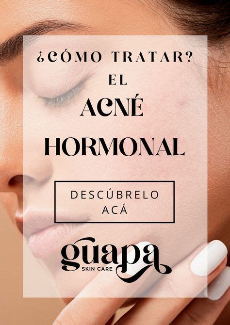 Te Contamos Qué Es El Acné Hormonal Sus Causas Y Como Tratarlo