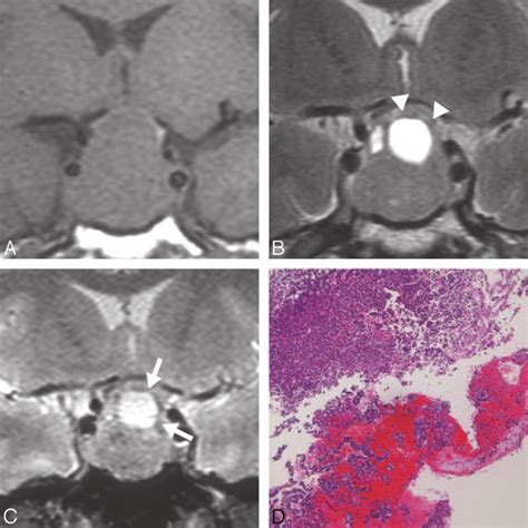 Patient 3 A 43 Year Old Man Had Typical Cysts In A Nonfunctioning