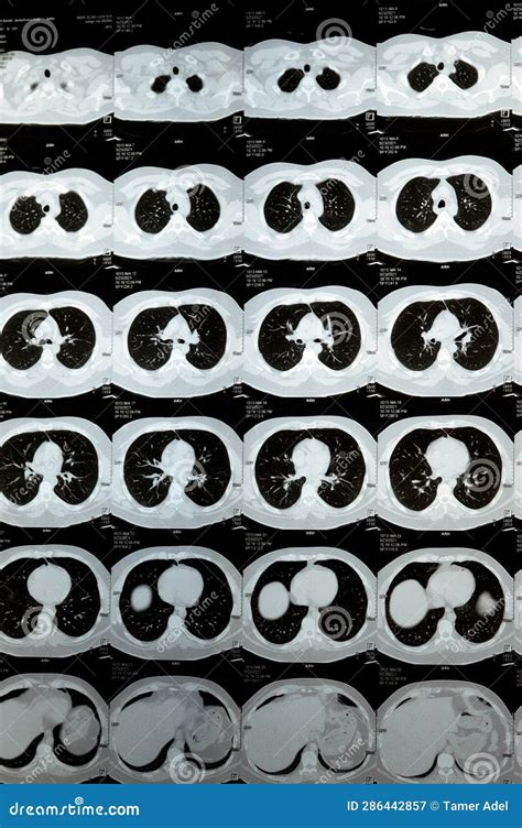 Multi Slice Ct Scan Of The Chest Showing Normal Study Normal