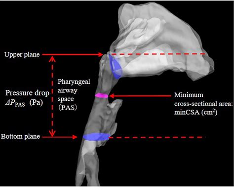 Figure 1 From Computational Fluid Dynamics Study Of The Pharyngeal