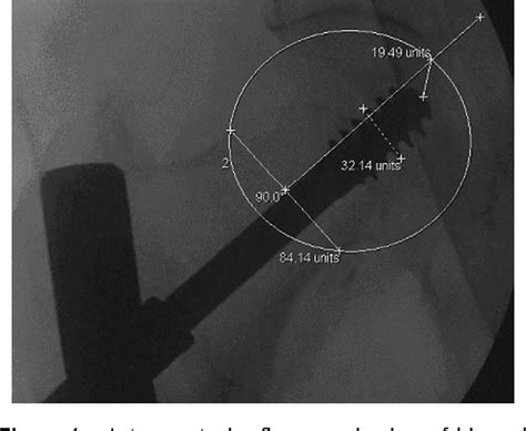 Figure 1 From Measuring Tip Apex Distance Using A Picture Archiving And