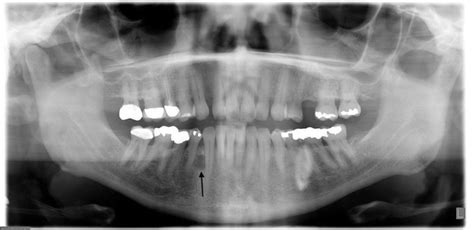 Orthopantomograph Showing A Well Circumscribed Radiolucent Area Between