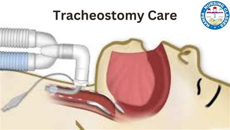 Tracheostomy Care A Comprehensive Guide Nanda Nursing Classes