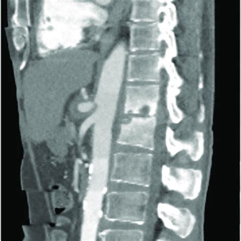 Computed Tomography Angiography Cta Displaying Sagittal View Of Focal