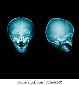 359 Hydrocephalus Images, Stock Photos & Vectors | Shutterstock