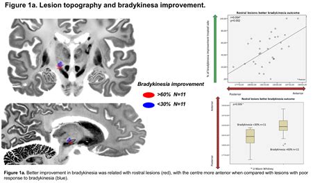 Focused Ultrasound Subthalamotomy In Parkinsons Disease Lesion