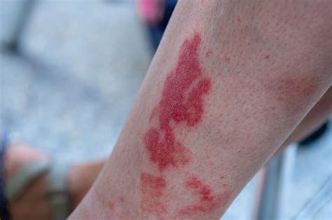 Signs Your Mystery Rash Is Something Serious Factspedia