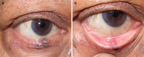 Basal Cell Carcinoma Eyelid Rodent Ulcer