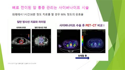 뼈로 전이된 암 통증 관리에 사이버나이프 시술을 추천 합니다