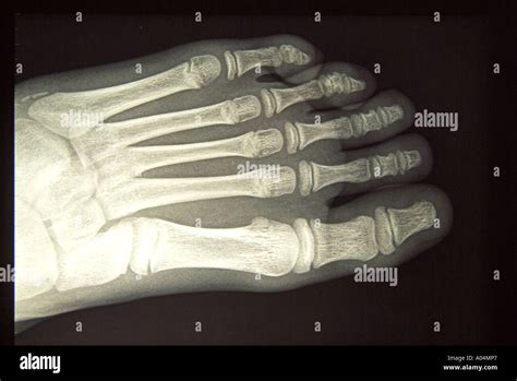 x ray of healthy 9 year old girl s left foot Stock Photo - Alamy