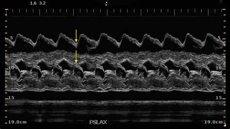 Ultrasound Zoom: On Cardiac Tamponade | FCEP