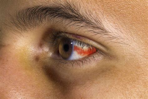 Blood In White Of Eye Causes Healing And When To Worry