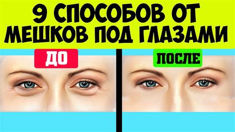 Как быстро избавиться от мешков под глазами? 9 эффективных способов от ...