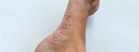 Fungal Rash On Top Of Foot