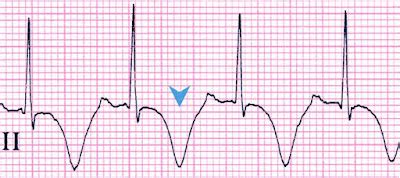 Study Medical Photos: Cerebral 'T waves' on ECG