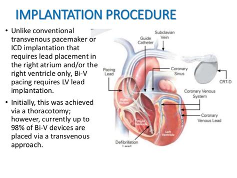 Cardiac Resynchronization Therapy Crt My Blog