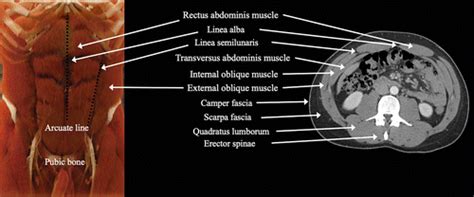 Imaging Of Abdominal Wall Masses Masslike Lesions And Diffuse Processes Radiographics