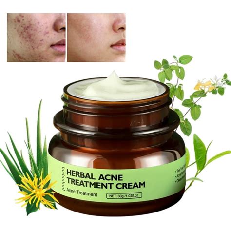 Acne Removal Cream Anti Acne Cream Control Oil And Reduce Acne Marks Herbal Acne Cream