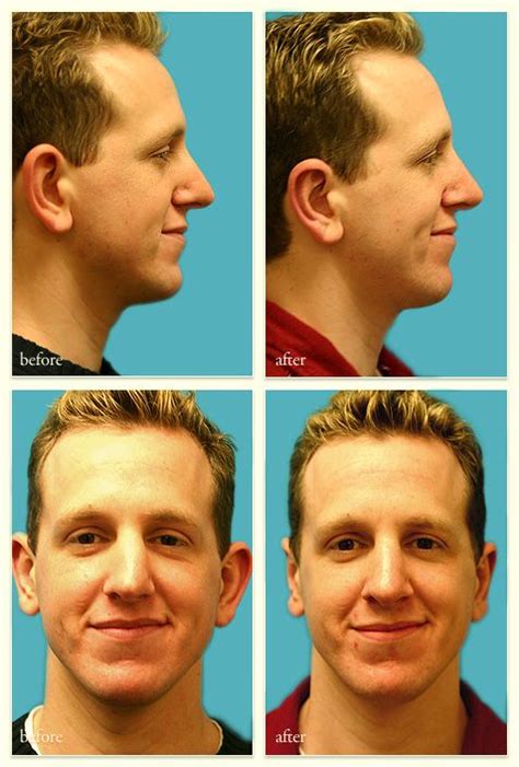 Ear Surgery Otoplasty Can Be Defined As The Reshaping And