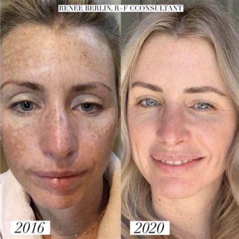 Absolute Collagen Before And After Pictures Skin Hair More Artofit