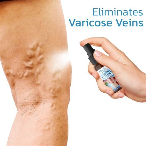 Get Rid Of Varicose Veins Artofit