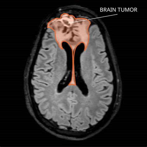 Oligodendroglioma - National Cancer Institute