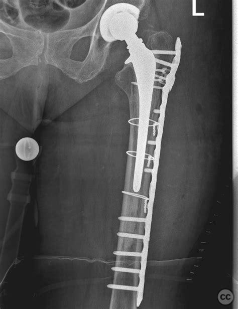 Vancouver B Periprosthetic Femur Fracture Lcp Broard Curved