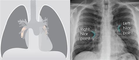 Chest Xray Approach To Hilum Epomedicine