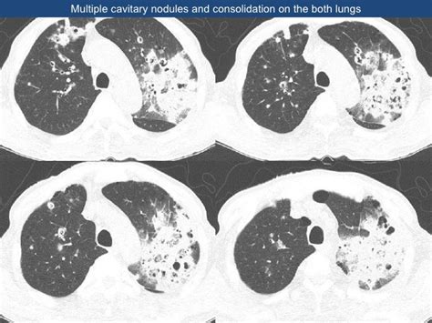 invasive aspergillosis