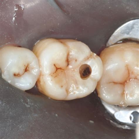 Pdf Restoring Proximal Caries Lesions Conservatively With Tunnel