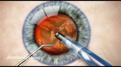 Cataract Surgery Process