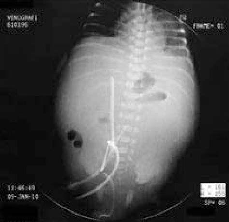 Plain Abdominal Radiography Shows A Distended Nearly Gasless Abdomen Download Scientific