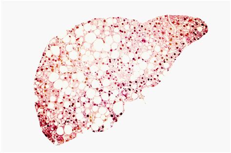 Study Links Severity of Psoriasis, Nonalcoholic Fatty Liver Disease