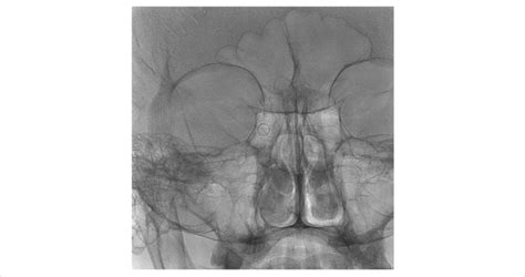 Radiograph of the flow-diverter stent /blue arrow/ 6 months after the... | Download Scientific ...