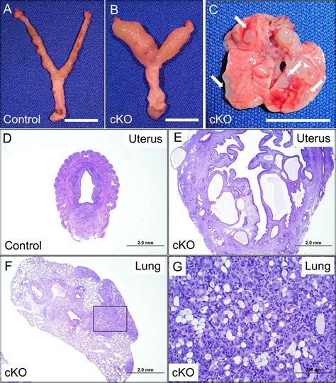 Activin Like Kinase 5 Alk5 Inactivation In The Mouse Uterus Results In Metastatic Endometrial