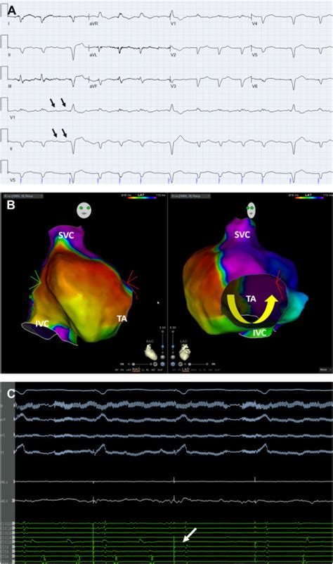 Restoring Sinus Rhythm In A Patient With Atrial Flutter And Left