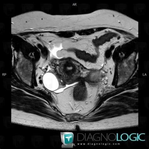 Cas Radiologie Endom Triome Irm Diagnologic